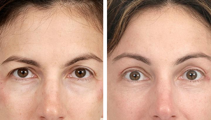 Brow Lift ve Temporal Lift