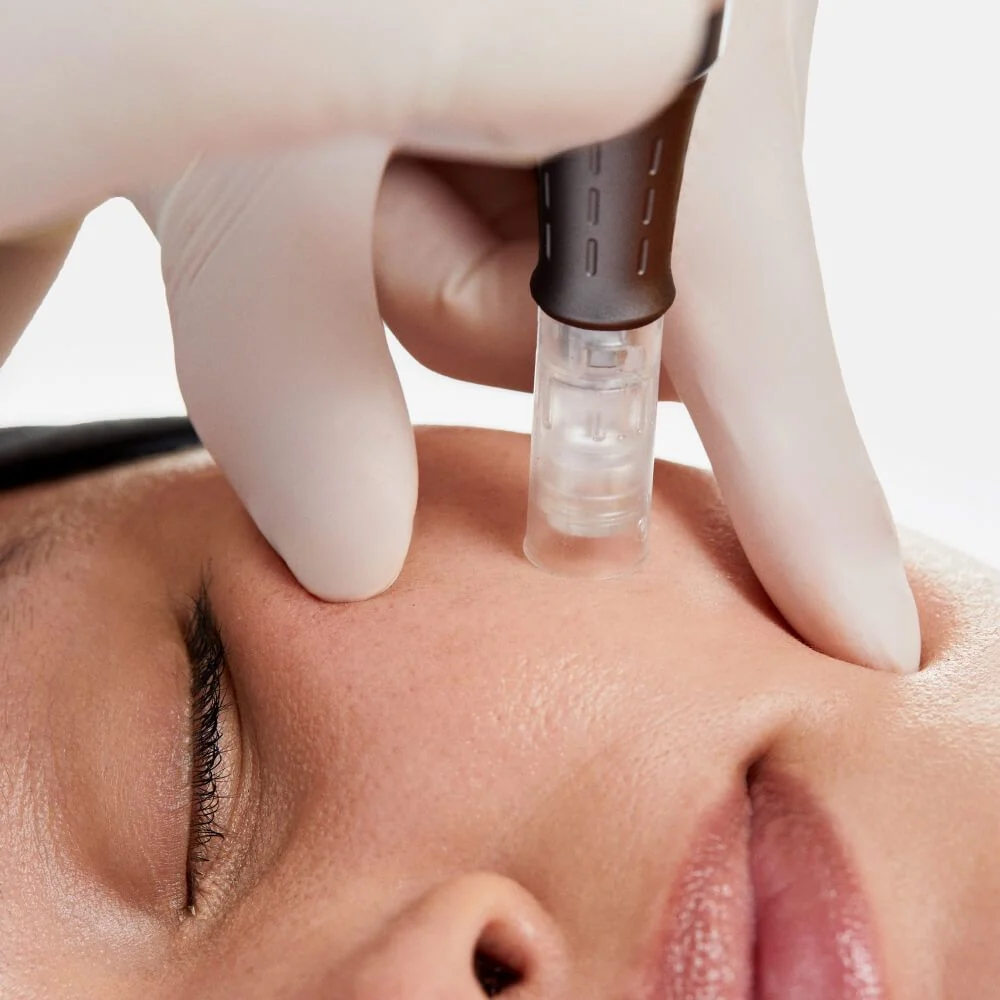 Mezoterapi İle Yüz Gençleştirme 1 Mesotherapy